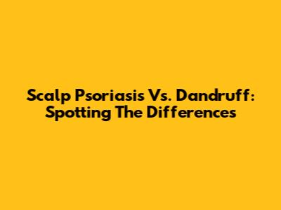 Scalp Psoriasis Vs. Dandruff: Spotting The Differences